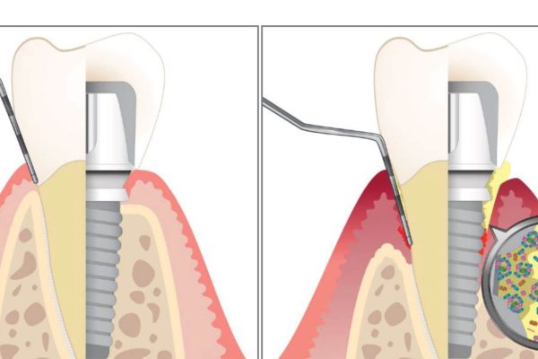 بیماری های ایمپلنت