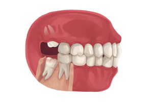 دندان عقل