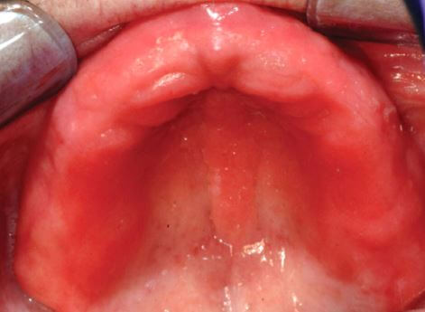  زخم دندان مصنوعی