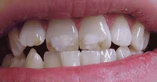 فلوروزیس دندانی