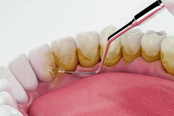 جرم گیری دندان