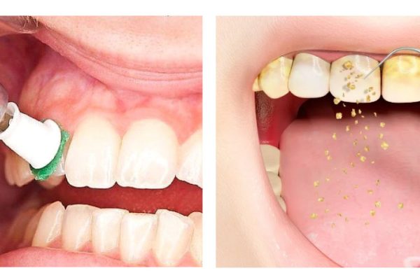 تفاوت پولیش و جرم گیری دندان