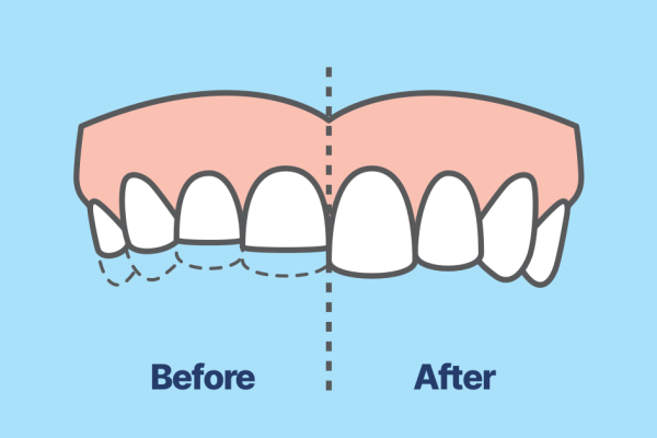 درمان دندان قروچه