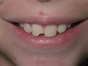 دندان لب پر شده