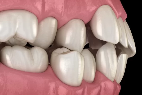 تغییر شکل دندان