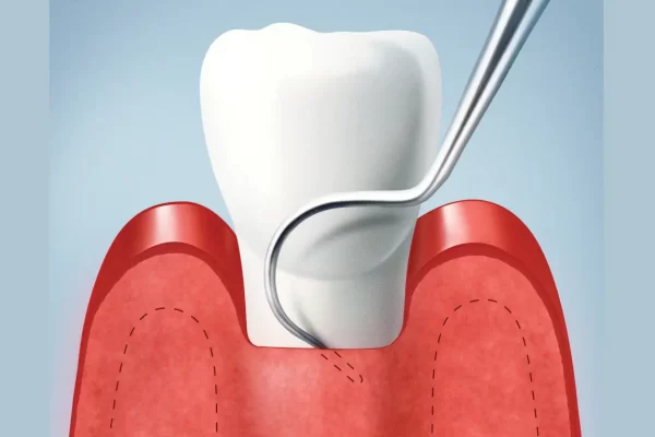 افزایش تاج دندان