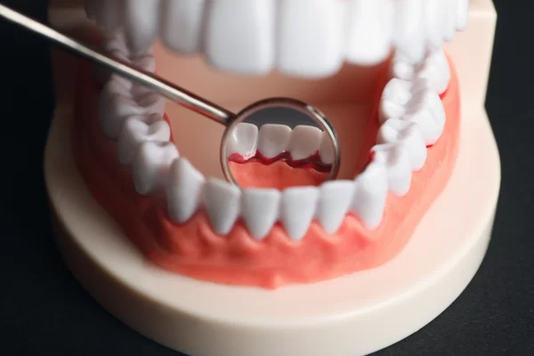 خونریزی لثه