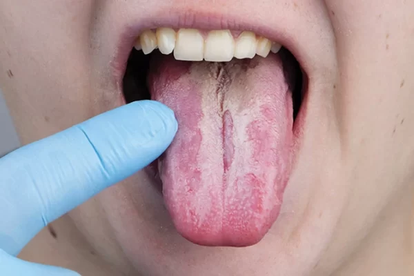  بیماری های دهان