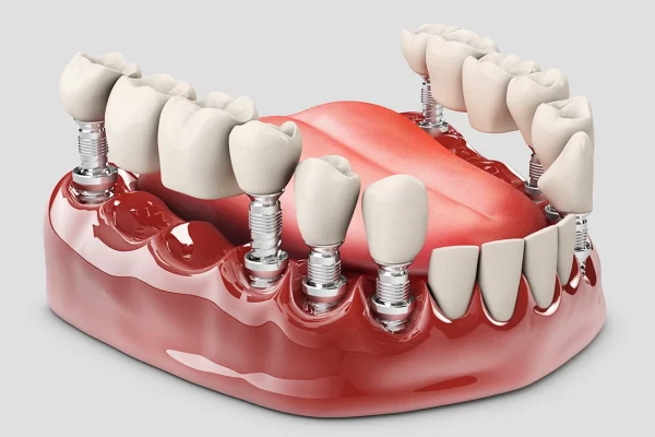 پروتز ثابت دندان چیست؟