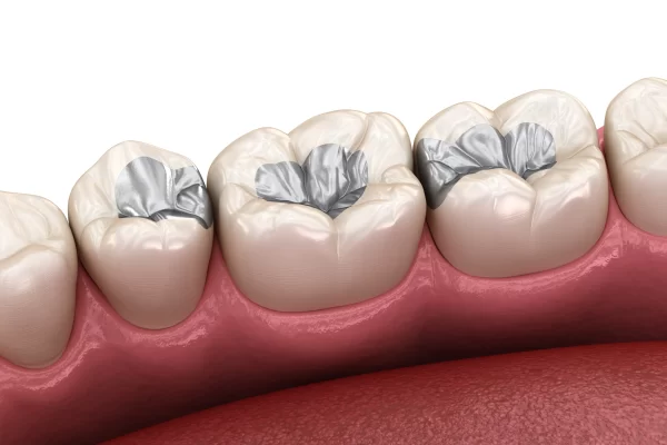 ترمیم دندان پوسیده 