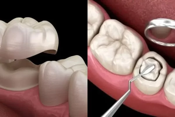 تفاوت کامپوزیت و روکش